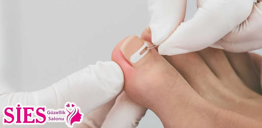 Midyat Batık Kıl ve Tırnak Tedavisi