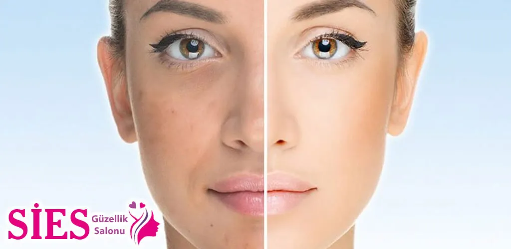 Midyat Leke Tedavisi