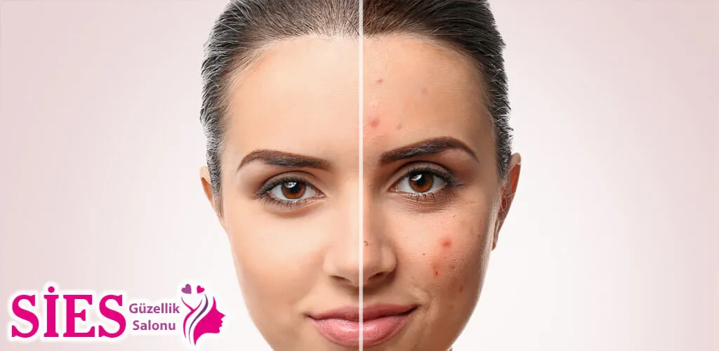Midyat Sivilce (akne) Tedavisi