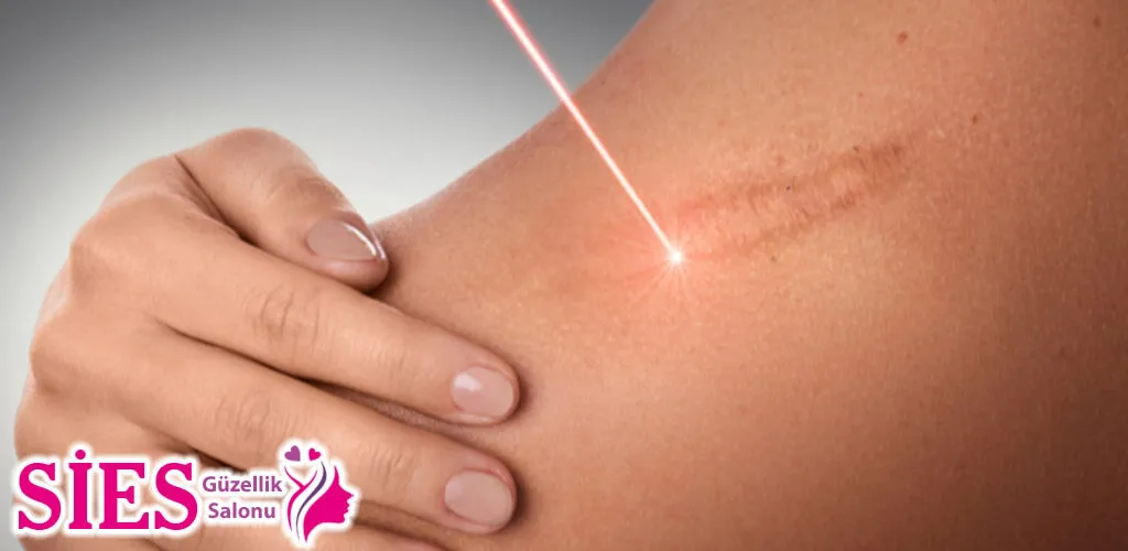 Midyat Yara İzi (Skar) Tedavisi